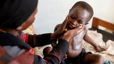 The Clade 1b strain of mpox has been particularly dangerous for children. Reuters